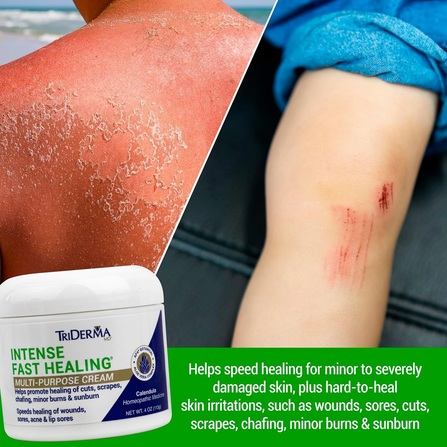 TriDerma Intense Fast Healing Cream, Decreases Healing Time for Minor Irritations, Rashes, Wounds, Cuts, Scrapes, Value Pack of 2-4 Ounce Jars